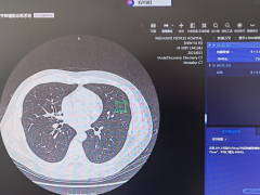AI医疗影像诊断系统：肺结节检出准确率超越人类医生